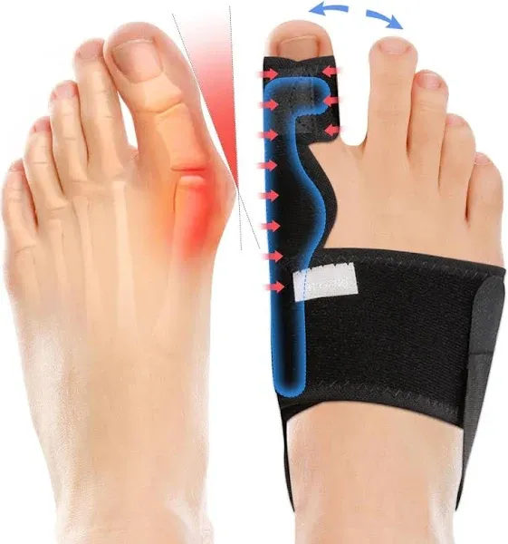 Fitgeno Bunion Corrector